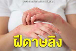 ฝีดาษลิง